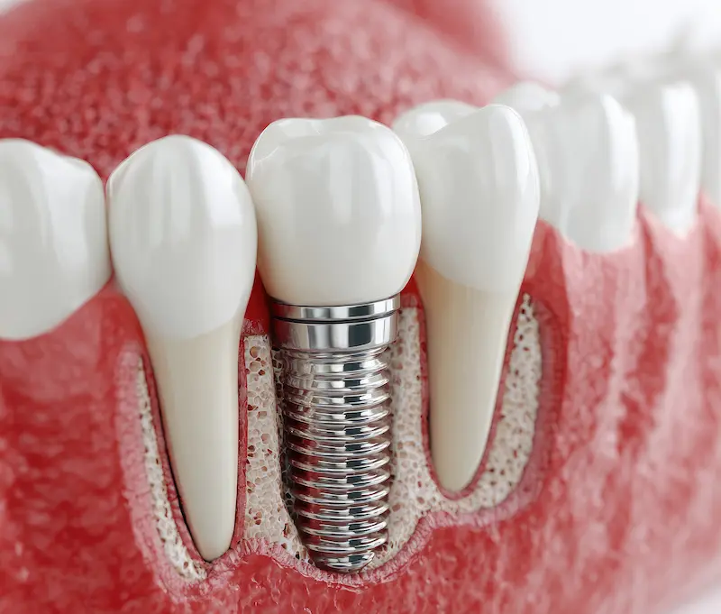 Modern dental implant care