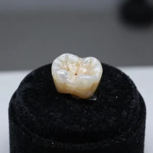 Premium Zirconia Crown Placement