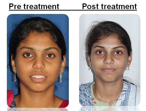 Patient smile transformation before and after front view